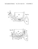 Tensioned Meniscus Prosthetic Devices and Associated Methods diagram and image