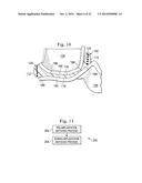 Tensioned Meniscus Prosthetic Devices and Associated Methods diagram and image