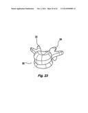 Prosthetic Spinal Disc Replacement and Methods Thereof diagram and image