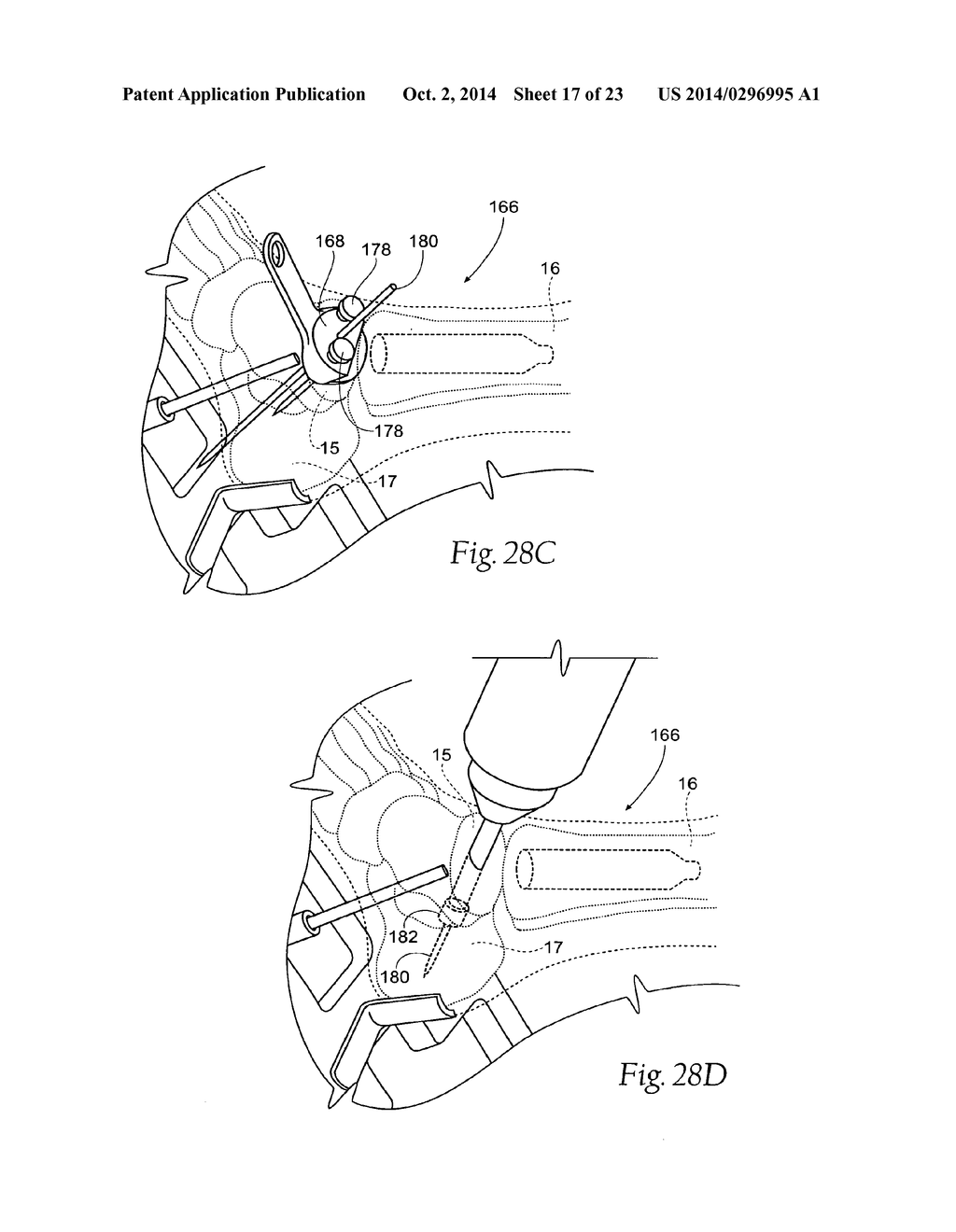 ANKLE REPLACEMENT SYSTEM - diagram, schematic, and image 18