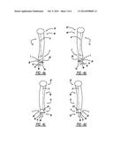 SYSTEM FOR CALCULATING FOREFOOT WEDGE ANGLE TO CORRECT     PRONATION/SUPINATION diagram and image