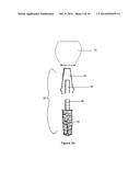 Method of dental implant restoration diagram and image