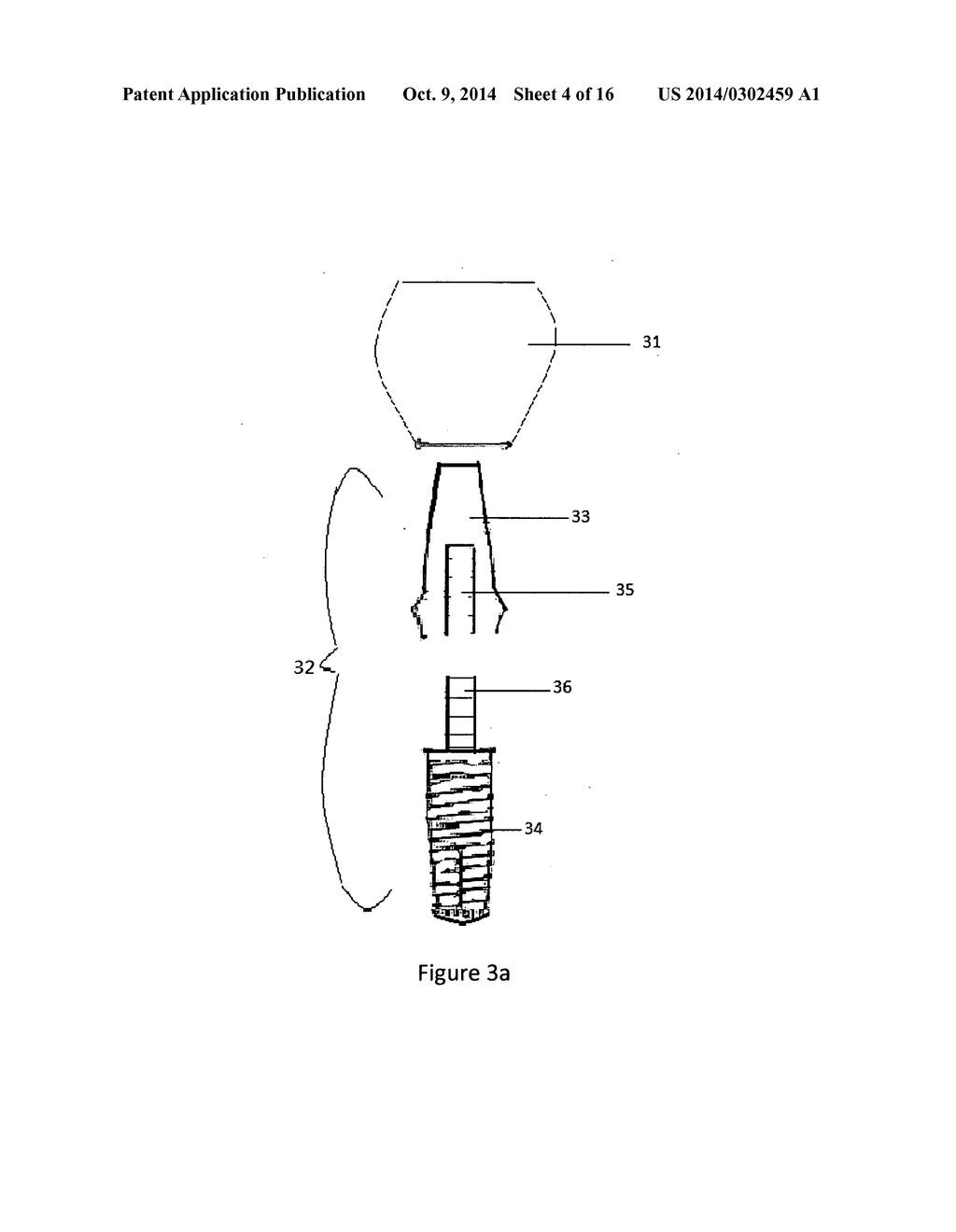 Method of dental implant restoration - diagram, schematic, and image 05