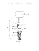 Method of dental implant restoration diagram and image