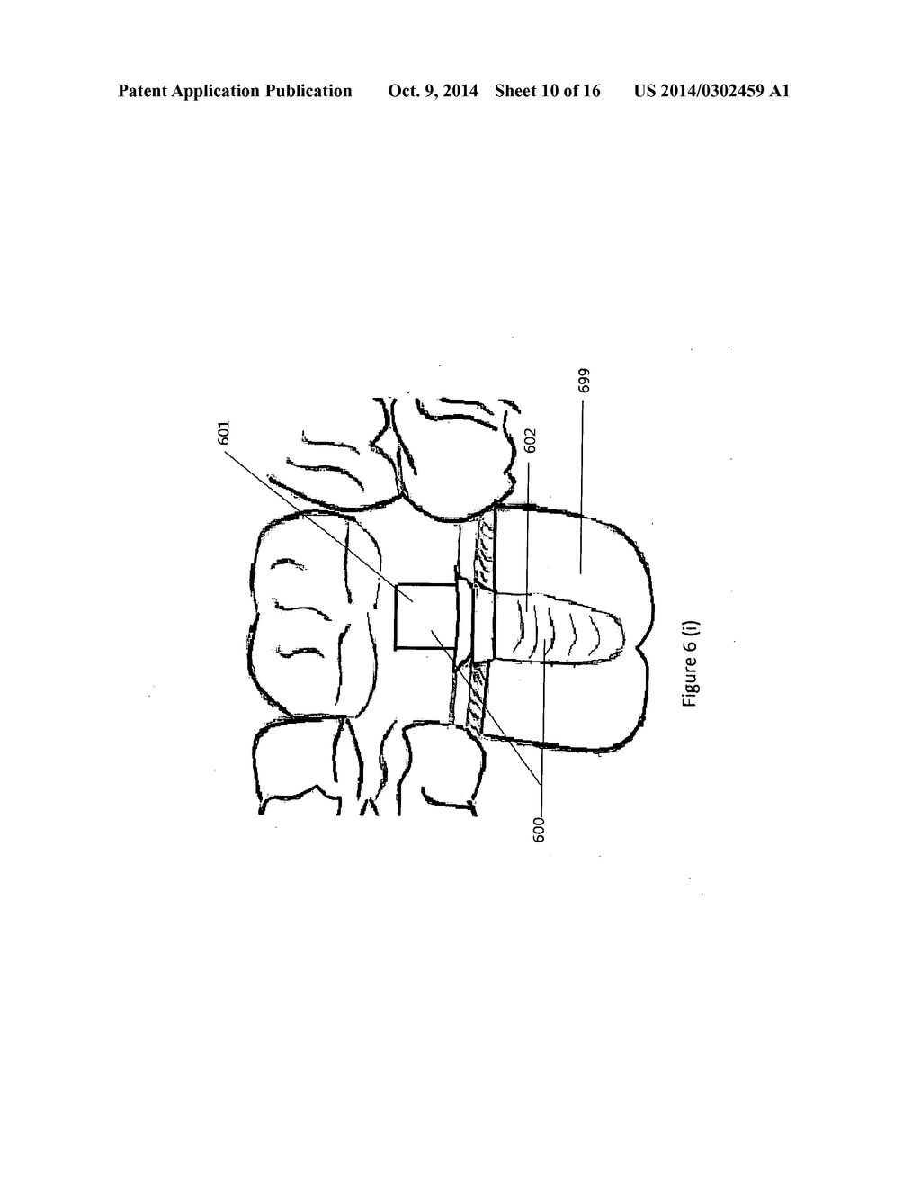 Method of dental implant restoration - diagram, schematic, and image 11