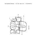 Method of dental implant restoration diagram and image