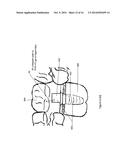 Method of dental implant restoration diagram and image