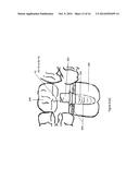 Method of dental implant restoration diagram and image