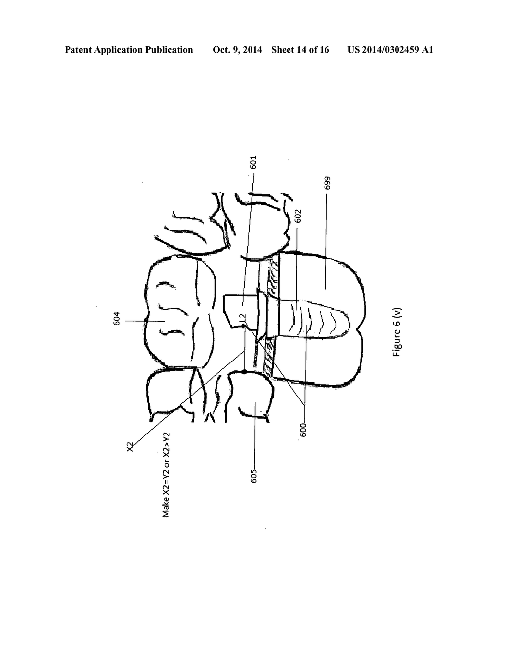 Method of dental implant restoration - diagram, schematic, and image 15