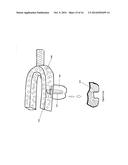 Method of dental implant restoration diagram and image