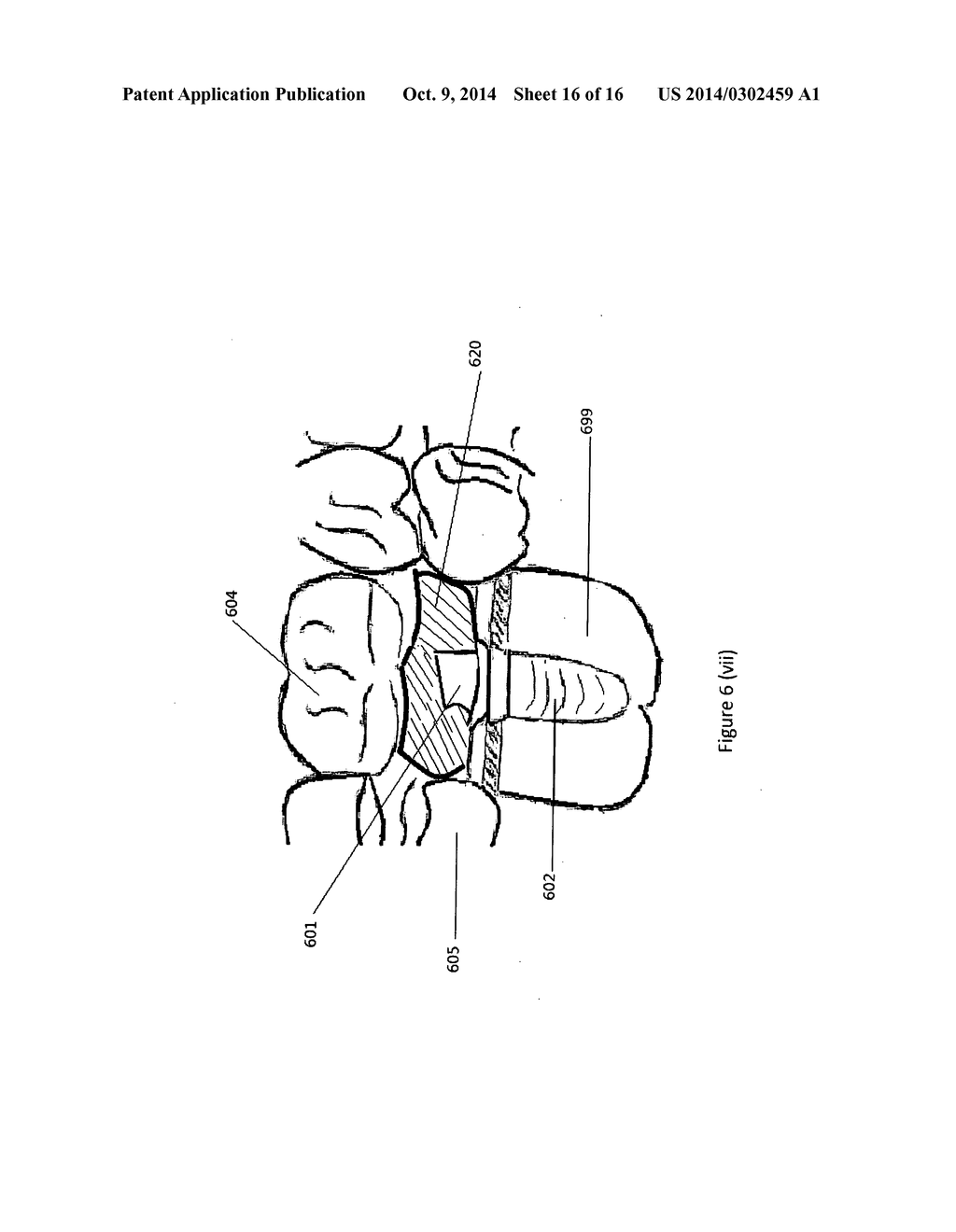 Method of dental implant restoration - diagram, schematic, and image 17