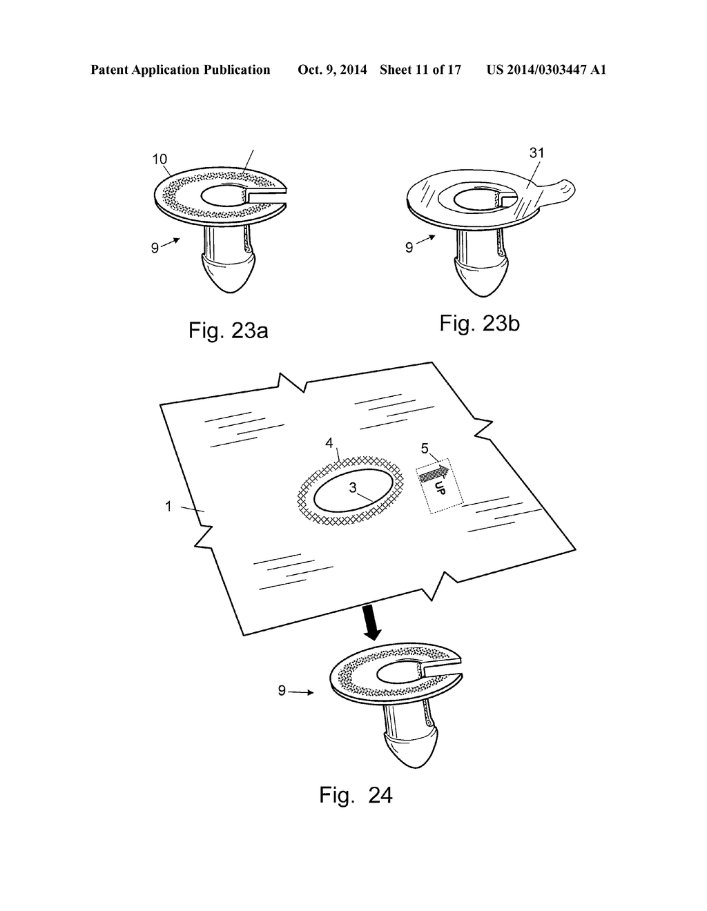 SURGICAL DRAPE SYSTEM FOR UROLOGY PROCEDURES ON FEMALE PATIENTS - diagram, schematic, and image 12