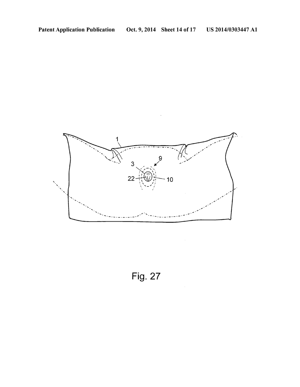 SURGICAL DRAPE SYSTEM FOR UROLOGY PROCEDURES ON FEMALE PATIENTS - diagram, schematic, and image 15