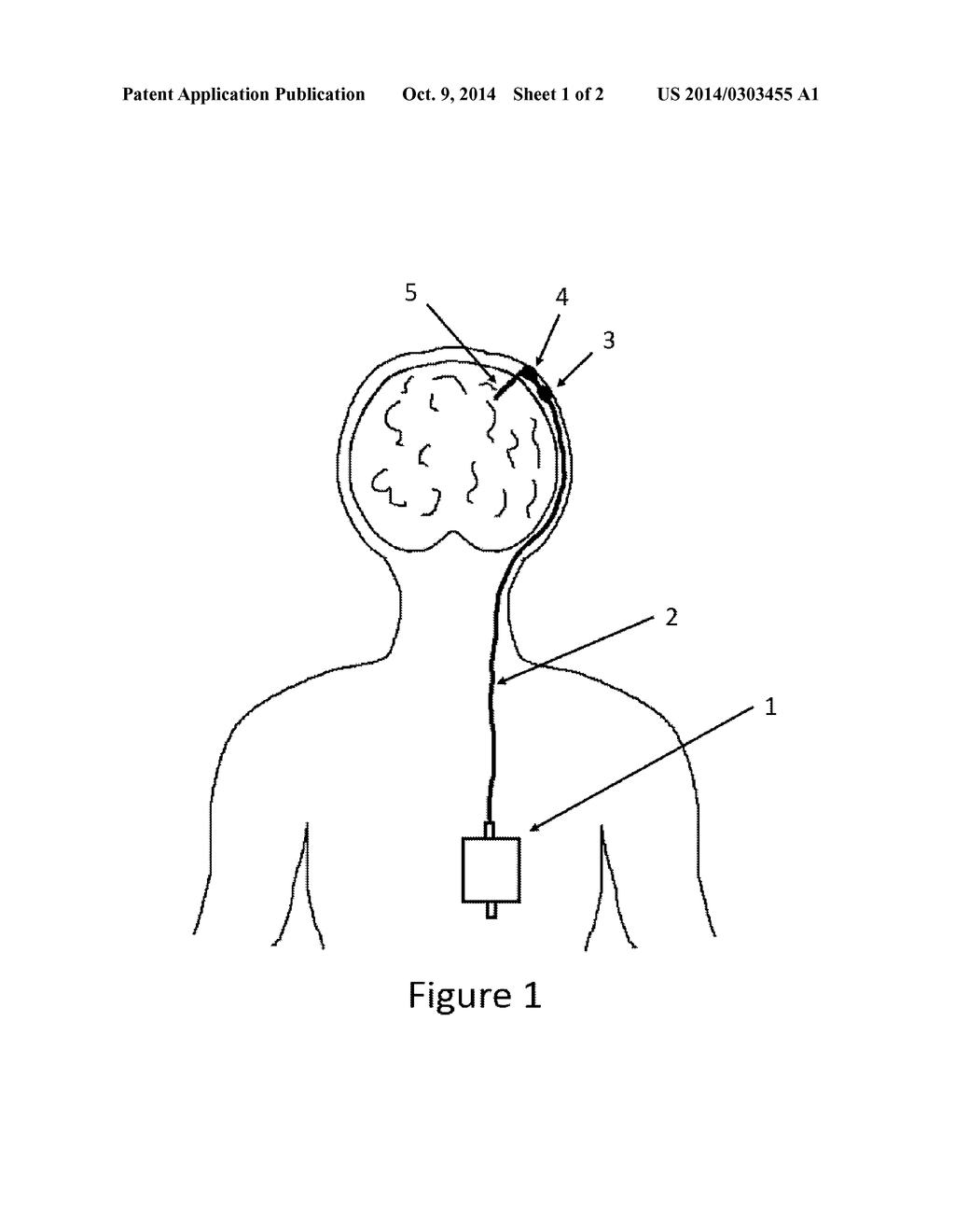 MULTIPURPOSE CEREBROSPINAL FLUID SENSOR ASSEMBLY AND METHOD OF OPERATION     OF THE SAME - diagram, schematic, and image 02