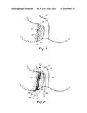 IMPLANTABLE PROSTHESIS FOR FISTULA REPAIR diagram and image