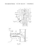 MULTI-DIRECTIONAL DEFLECTABLE CATHETER APPARATUSES, SYSTEMS, AND METHODS     FOR RENAL NEUROMODULATION diagram and image