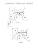 MULTI-DIRECTIONAL DEFLECTABLE CATHETER APPARATUSES, SYSTEMS, AND METHODS     FOR RENAL NEUROMODULATION diagram and image