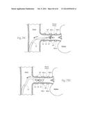 MULTI-DIRECTIONAL DEFLECTABLE CATHETER APPARATUSES, SYSTEMS, AND METHODS     FOR RENAL NEUROMODULATION diagram and image