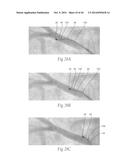 MULTI-DIRECTIONAL DEFLECTABLE CATHETER APPARATUSES, SYSTEMS, AND METHODS     FOR RENAL NEUROMODULATION diagram and image