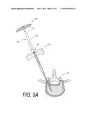 BONE TREATMENT SYSTEMS AND METHODS diagram and image