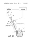 BONE TREATMENT SYSTEMS AND METHODS diagram and image