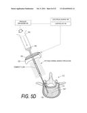 BONE TREATMENT SYSTEMS AND METHODS diagram and image