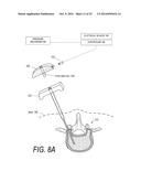 BONE TREATMENT SYSTEMS AND METHODS diagram and image