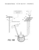 BONE TREATMENT SYSTEMS AND METHODS diagram and image