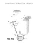 BONE TREATMENT SYSTEMS AND METHODS diagram and image