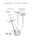 BONE TREATMENT SYSTEMS AND METHODS diagram and image