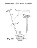 BONE TREATMENT SYSTEMS AND METHODS diagram and image