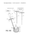 BONE TREATMENT SYSTEMS AND METHODS diagram and image