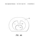 Intraocular Lens Injector Cartridge Providing Lens Control diagram and image