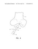 INTERFERENCE WEDGE FOR SECURING AN ANTERIOR CRUCIATE LIGAMENT GRAFT IN A     BONE TUNNEL diagram and image