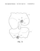 INTERFERENCE WEDGE FOR SECURING AN ANTERIOR CRUCIATE LIGAMENT GRAFT IN A     BONE TUNNEL diagram and image