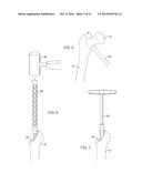 TOTAL HIP ARTHROPLASTY diagram and image