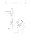 TOTAL HIP ARTHROPLASTY diagram and image