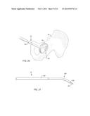 TOTAL HIP ARTHROPLASTY diagram and image