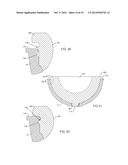 TOTAL HIP ARTHROPLASTY diagram and image