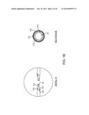 BALLOON CATHETER METHOD FOR REDUCING RESTENOSIS VIA IRREVERSIBLE     ELECTROPORATION diagram and image