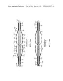 BALLOON CATHETER METHOD FOR REDUCING RESTENOSIS VIA IRREVERSIBLE     ELECTROPORATION diagram and image