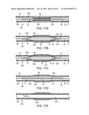 BALLOON CATHETER METHOD FOR REDUCING RESTENOSIS VIA IRREVERSIBLE     ELECTROPORATION diagram and image