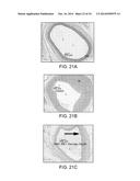 BALLOON CATHETER METHOD FOR REDUCING RESTENOSIS VIA IRREVERSIBLE     ELECTROPORATION diagram and image