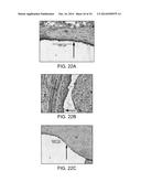 BALLOON CATHETER METHOD FOR REDUCING RESTENOSIS VIA IRREVERSIBLE     ELECTROPORATION diagram and image