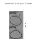 BALLOON CATHETER METHOD FOR REDUCING RESTENOSIS VIA IRREVERSIBLE     ELECTROPORATION diagram and image