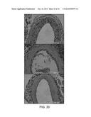 BALLOON CATHETER METHOD FOR REDUCING RESTENOSIS VIA IRREVERSIBLE     ELECTROPORATION diagram and image