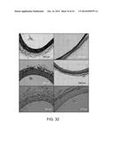 BALLOON CATHETER METHOD FOR REDUCING RESTENOSIS VIA IRREVERSIBLE     ELECTROPORATION diagram and image