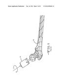 INSTRUMENT FOR RESHAPING THE HEAD OF A FEMUR diagram and image