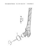 INSTRUMENT FOR RESHAPING THE HEAD OF A FEMUR diagram and image