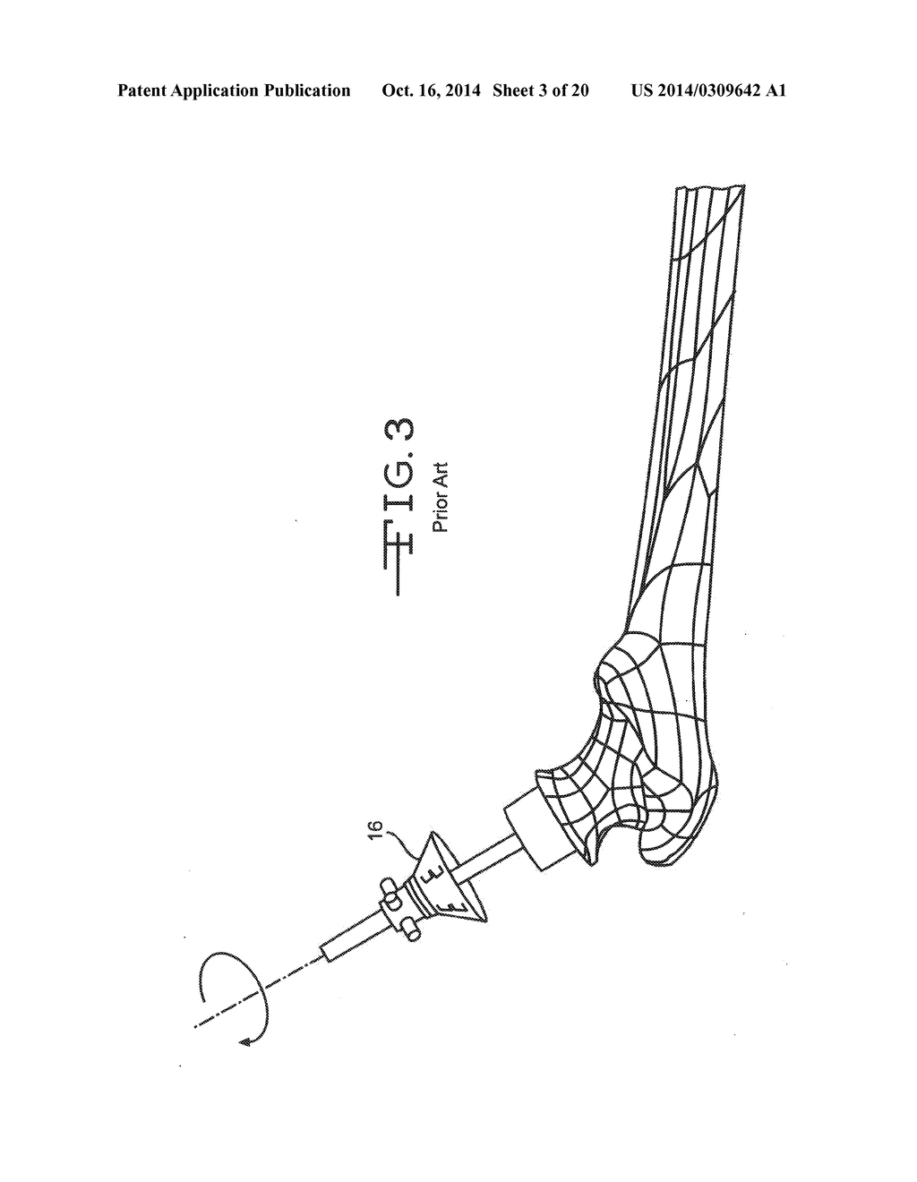 INSTRUMENT FOR RESHAPING THE HEAD OF A FEMUR - diagram, schematic, and image 04